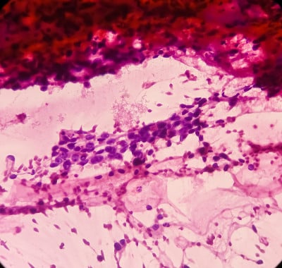胰腺肿块(CT引导FNA):恶性细胞、腺癌、非典型上皮细胞阳性