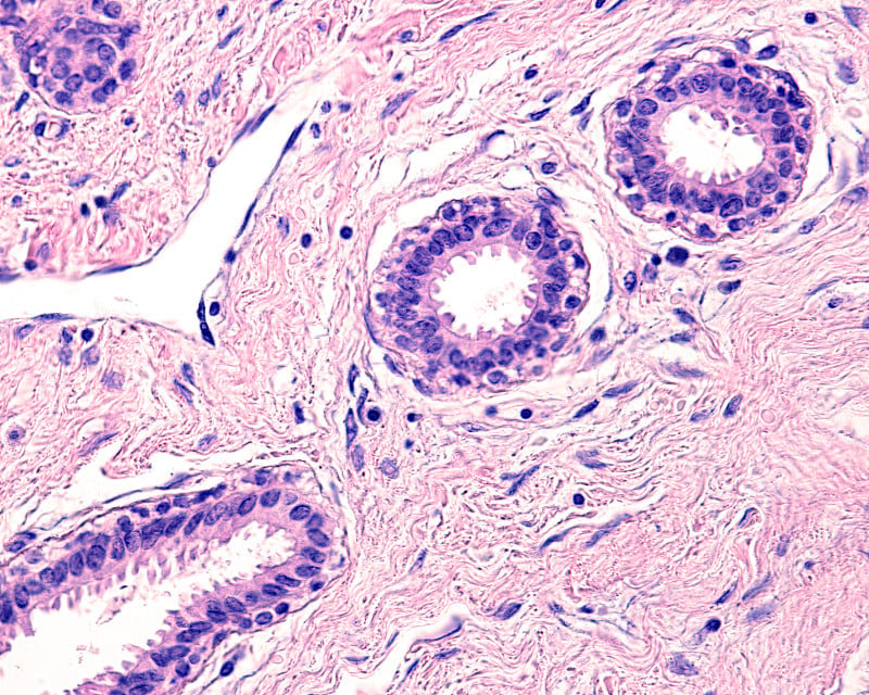 人类的乳房。柱状细胞腺病或钝导管腺病