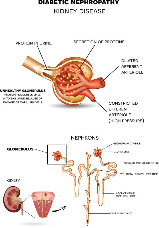 糖尿病肾病，肾病