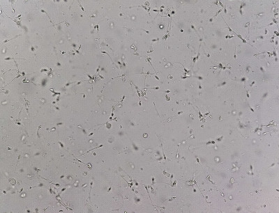 弱精子症的精液分析显微照片。