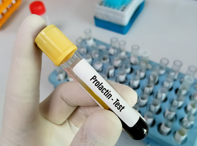 抽血作催乳激素检查。健康和医学概念。