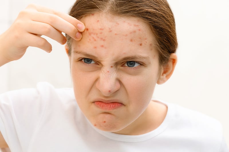 她看着镜子里的自己，用手触摸着脸上的痘痘、美丽和健康的概念