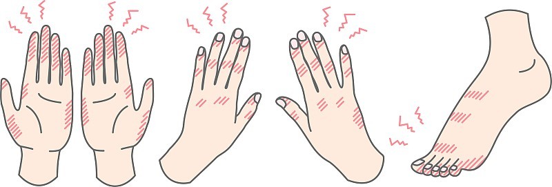 手脚冻疮插图