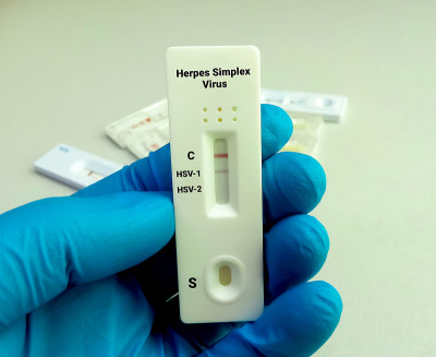 近距离观察技术人员或技术人员手持设备对单纯疱疹病毒(HSV)病毒进行快速筛查试验，显示阳性结果。