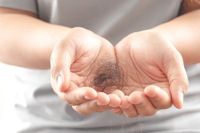 女性对洗发水过敏会导致脱发和头皮屑。
