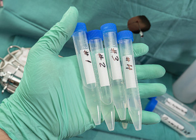 横贯脊髓炎患者注射牛津covid-19实验疫苗后，装有4个脑脊液样本的小瓶，概念图像
