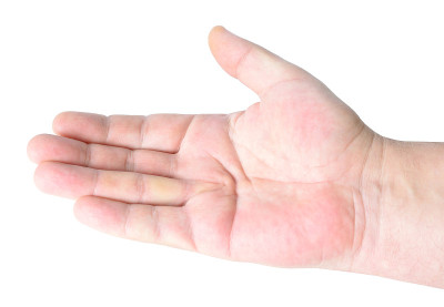 dupuytrenn挛缩，也称为dupuytrenn病，Morbus dupuytrenn，维京病，