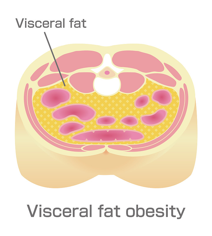 肥胖症的例子。腹部切面(内脏脂肪)。