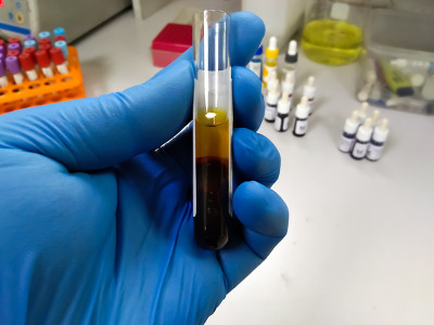 科学家手持高胆红素血症血清血液样管进行胆红素试验。