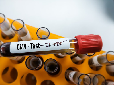 血液标本巨细胞病毒(CMV)阳性，实验室背景，聚焦视图