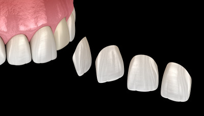 中切牙和侧切牙贴面安装程序。医学上准确的牙齿3D插图