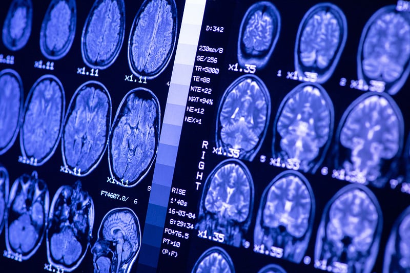 健康人在蓝色照明下的脑部MRI。磁共振扫描。医疗保健的概念