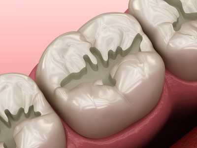 准备的磨牙裂填补安置，医学上精确的3D插图牙科概念