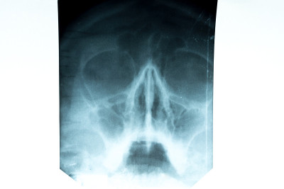 X-ray of the nasal septum.