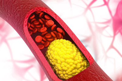 堵塞Arterie