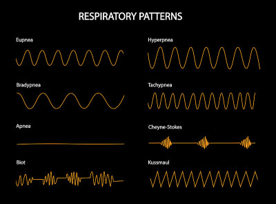 Respiratoy模式。不同情况下的呼吸曲线。呼吸暂停，呼吸过度，呼吸过缓，呼吸过速，呼吸暂停，夏