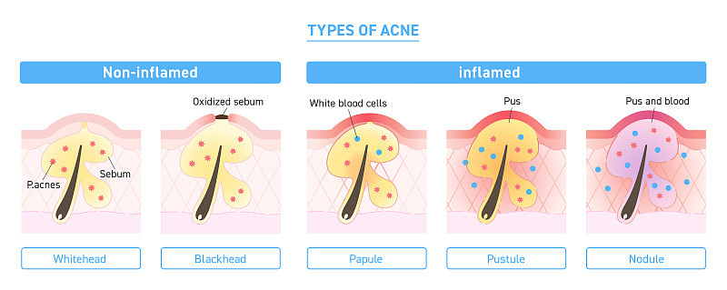 Illustration of types of acne with explanation