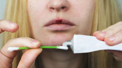 一名妇女涂了疱疹药膏