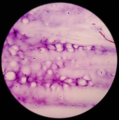 腕关节(FNA):神经节细胞，镜下可见泡沫组织细胞、淋巴细胞及背景蛋白