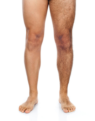男性腿部脱毛