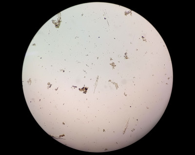 人尿标本中血球寄生血吸虫显微镜下观察。尿寄生虫