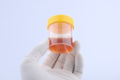 尿瓶试验