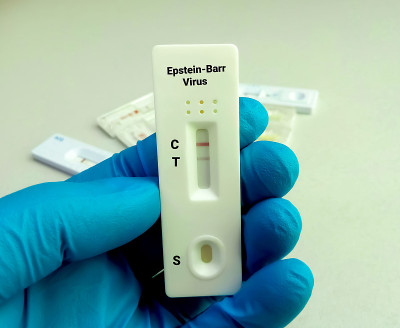 近距离观察技术人员或技术人员手持eb病毒(EBV)快速筛查试验装置，结果呈阳性。