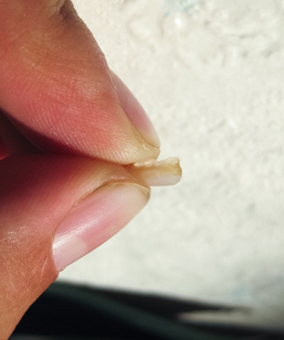 用割刀从旧填料上掉下来。牙齿的封印。