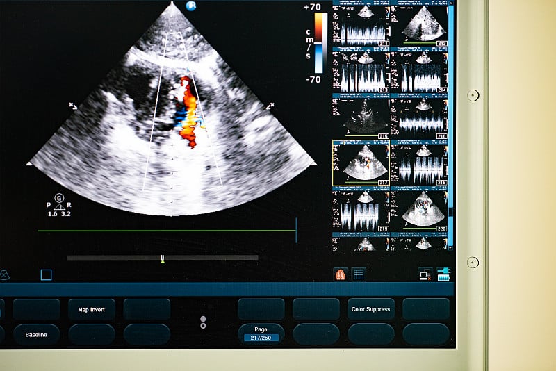 用多普勒方法监测血流的现代超声扫描仪。