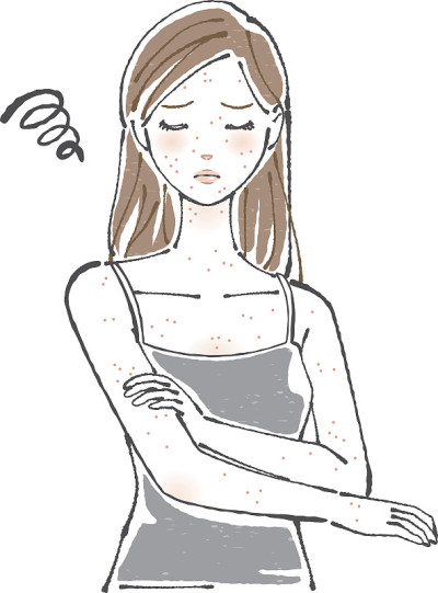 一个有湿疹的女人