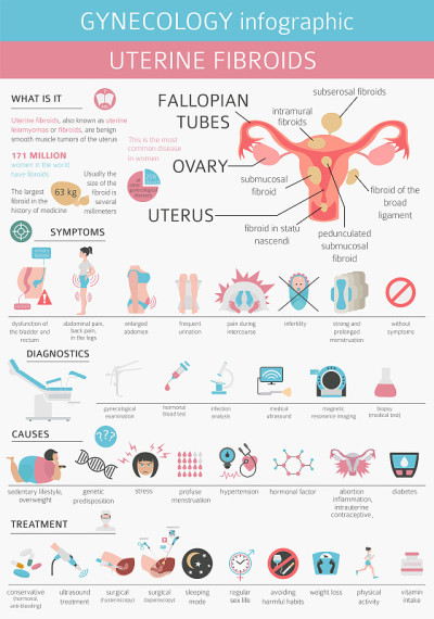 子宫平滑肌瘤。女性Ginecological medical disease信息图表