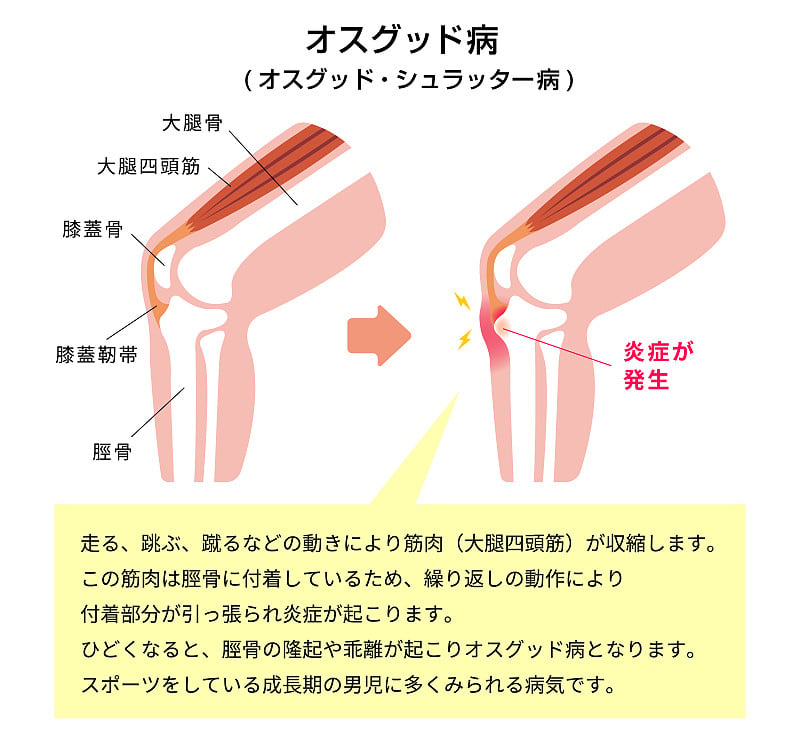 osgood - schater病(膝关节病)图解(附说明文字)/日语