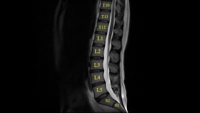 腰椎MRI(磁共振)下背部疼痛成像