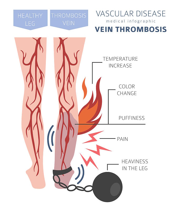 血管疾病。静脉血栓形成症状，治疗图标设置。医疗信息图表设计