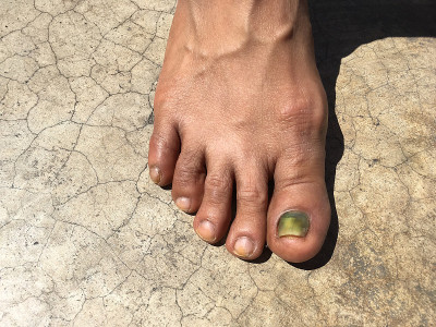 化疗和指甲颜色变了