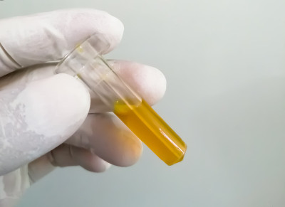技师戴着手套手持高胆红素血清样本，用于诊断黄疸病。