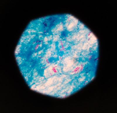 蓝背上有结核杆菌3+中等红细胞