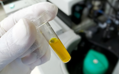 生物化学家持有高胆红素血清样本用于诊断黄疸病。