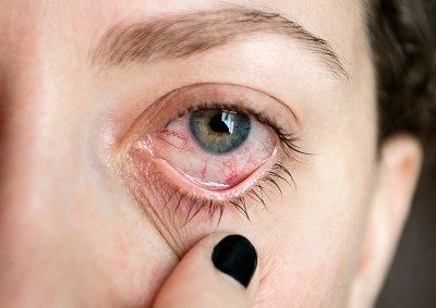 Ð¡onjunctivitis。流行性感冒。女人的眼睛。眼部疾病。收盘上涨