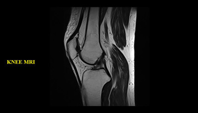 膝关节MRI(磁共振成像)