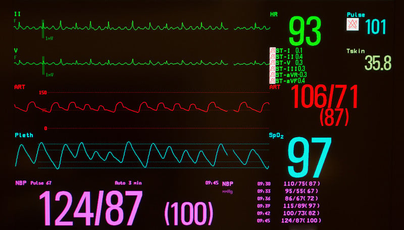 黑屏监护仪上的心房扑动和生命体征