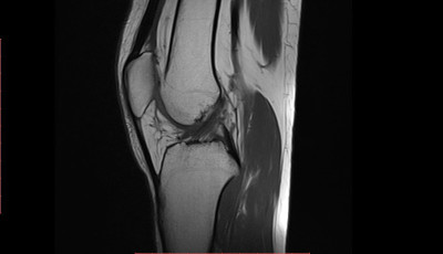 膝关节MRI(磁共振成像)