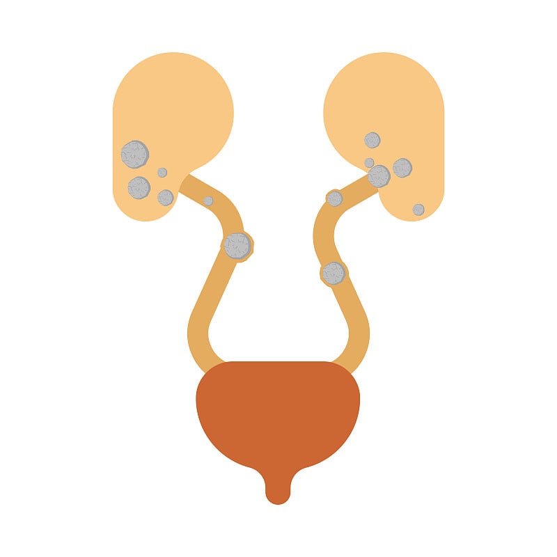 石头在肾脏。肾结石病。医疗矢量图