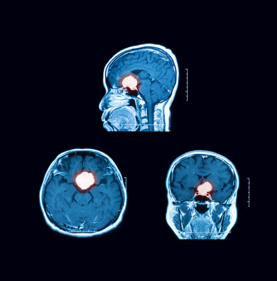 磁共振成像(MRI)与脑部扫描对比。矢状面、横切面和冠状面
