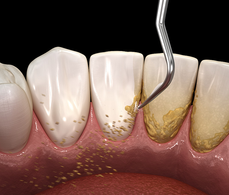 口腔卫生:超声波洁牙机，清除牙石和牙菌斑。医学上精确的人类牙齿治疗的3D插图