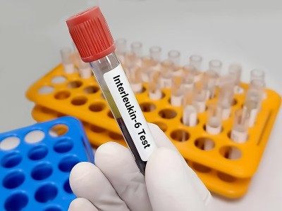 生物化学家或实验室技术人员持有血液样本进行白细胞介素-6 (IL-6)测试，一种炎症细胞因子，抗炎肌