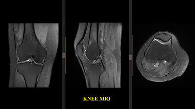 膝关节MRI(磁共振成像)