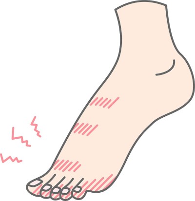 脚上冻疮的插图