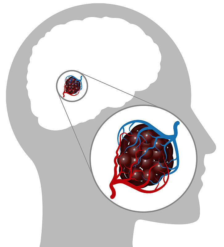 海绵状血管瘤是一种血管异常，其特征是大的，相邻的毛细血管，很少或没有干预大脑。