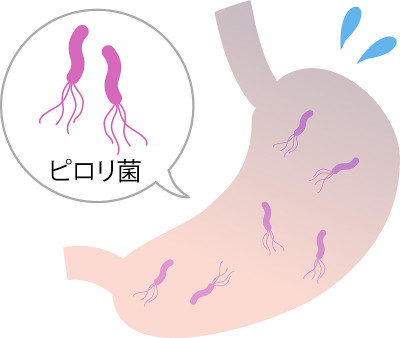 幽门螺杆菌/人体/胃影像